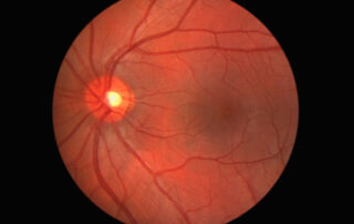 Photo of the human eye's retina
